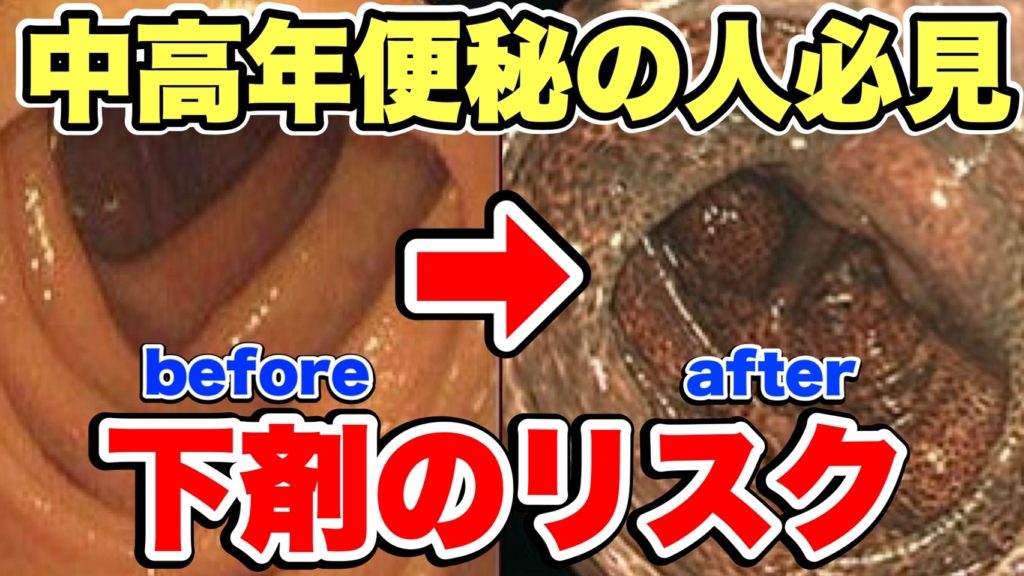 【便秘の中高年注意】下剤服用が引き起こす大腸メラノーシス